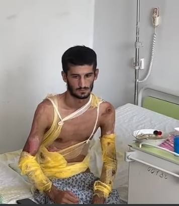 Başçıya etiraz olaraq özünü yandıran Qarabağ Qazisi AĞIR DURUMDA...